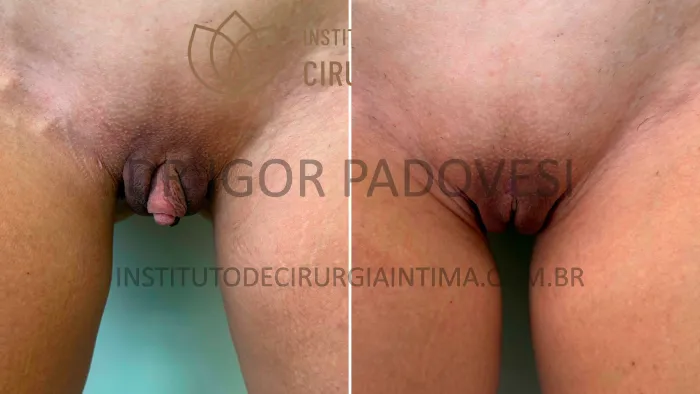 clitoroplastias_exemplos_dr_igor_padovesi_set26_Página_04 1_1x