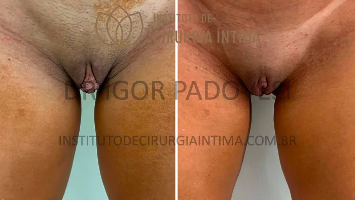 clitoroplastias_exemplos_dr_igor_padovesi_set26_Página_05 1_1x