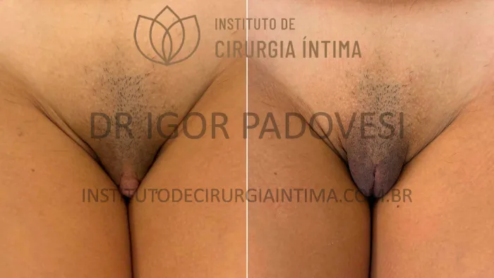 clitoroplastias_exemplos_dr_igor_padovesi_set26_Página_07 1_1x