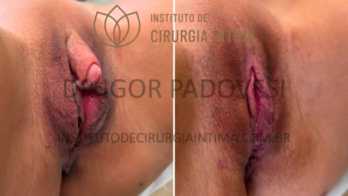 clitoroplastias_exemplos_dr_igor_padovesi_set26_Página_08 1_1x