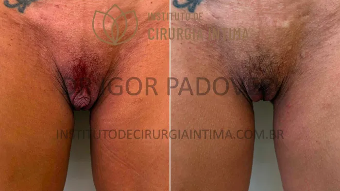 clitoroplastias_exemplos_dr_igor_padovesi_set26_Página_10 1_1x