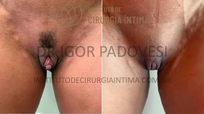 clitoroplastias_exemplos_dr_igor_padovesi_set26_Página_11 1_1x