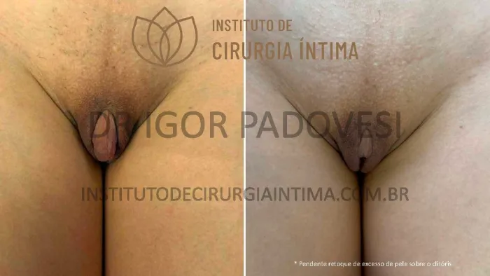 clitoroplastias_exemplos_dr_igor_padovesi_set26_Página_12 1_1x
