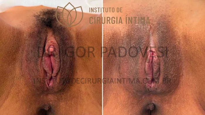 clitoroplastias_exemplos_dr_igor_padovesi_set26_Página_16 1_1x