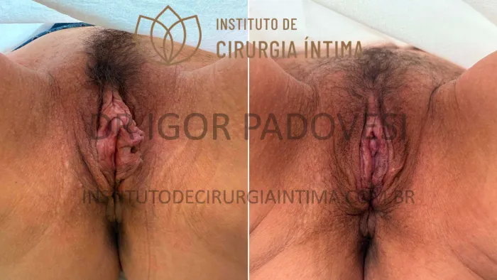 clitoroplastias_exemplos_dr_igor_padovesi_set26_Página_17 1_1x