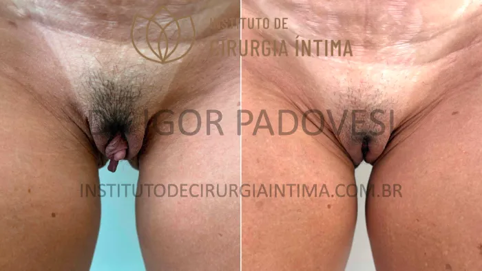 clitoroplastias_exemplos_dr_igor_padovesi_set26_Página_19 1_1x