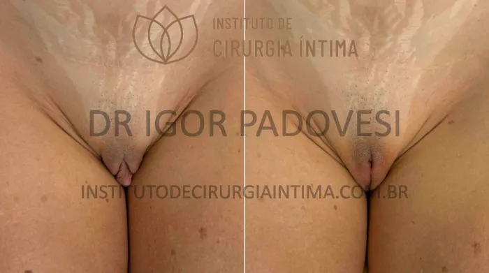 clitoroplastias_exemplos_dr_igor_padovesi_set26_Página_20 1_1x