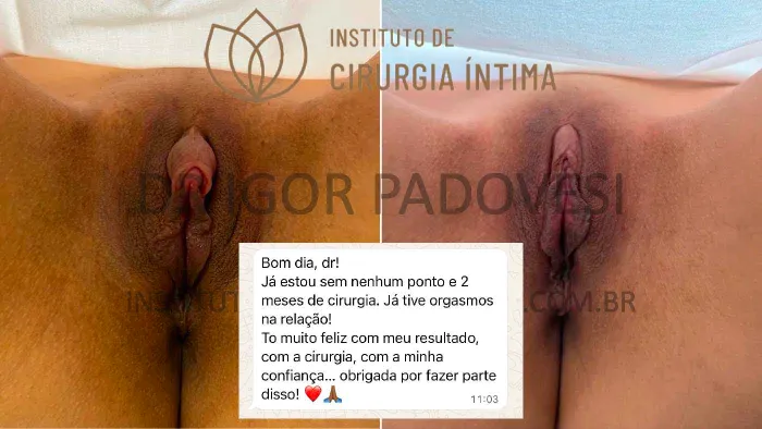 clitoroplastias_exemplos_dr_igor_padovesi_set26_Página_22 1_1x