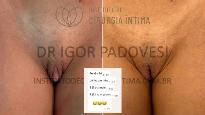 clitoroplastias_exemplos_dr_igor_padovesi_set26_Página_23 1_1x