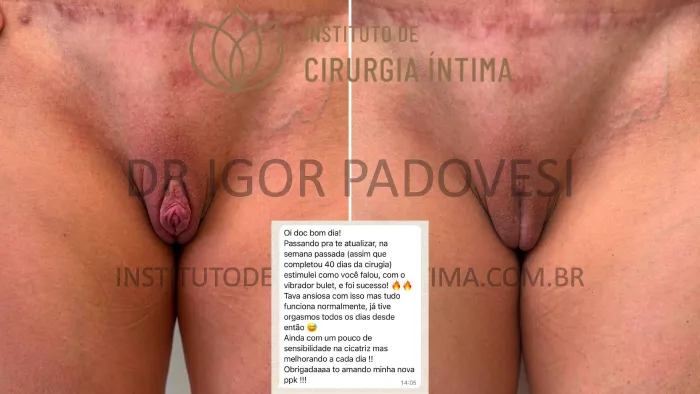 clitoroplastias_exemplos_dr_igor_padovesi_set26_Página_24 1_1x