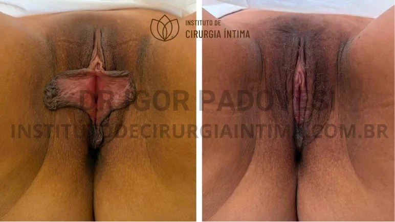 exemplos_ninfoplastias_capuz_clitoriano_set26_part1_Página_01_Imagem_0001 1_1x