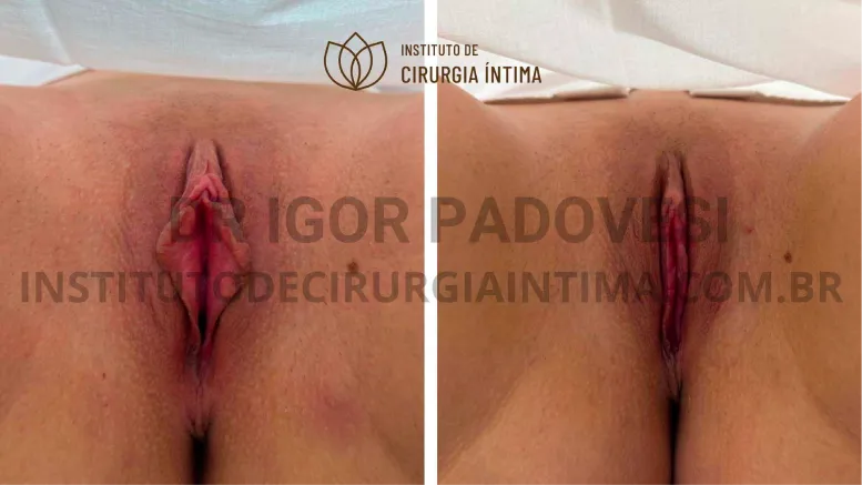 exemplos_ninfoplastias_capuz_clitoriano_set26_part1_Página_02_Imagem_0001 1_1x