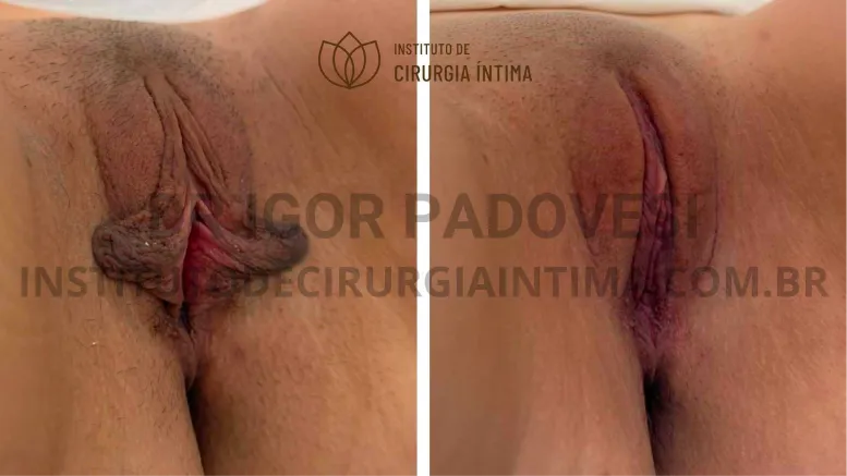 exemplos_ninfoplastias_capuz_clitoriano_set26_part1_Página_06_Imagem_0001 1_1x