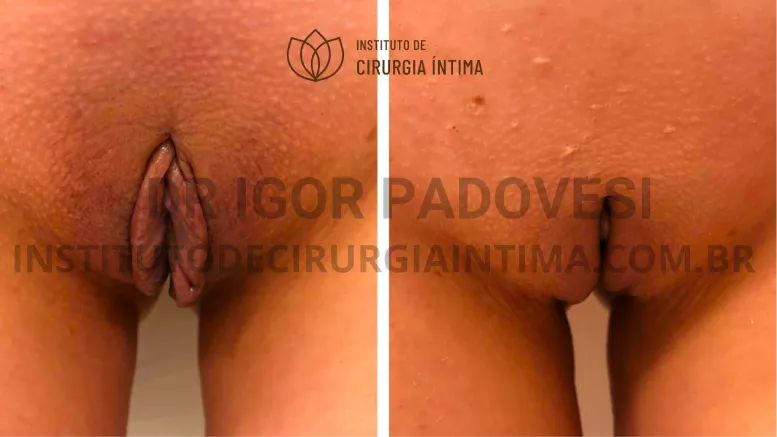 exemplos_ninfoplastias_capuz_clitoriano_set26_part1_Página_07_Imagem_0001 1_1x