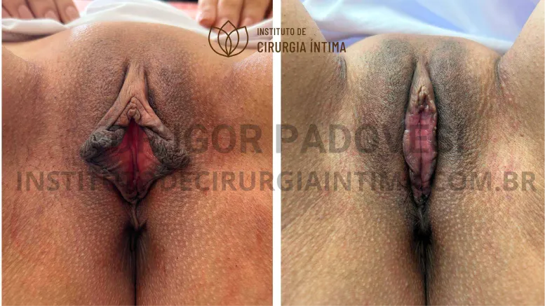 exemplos_ninfoplastias_capuz_clitoriano_set26_part1_Página_10_Imagem_0001 1_1x