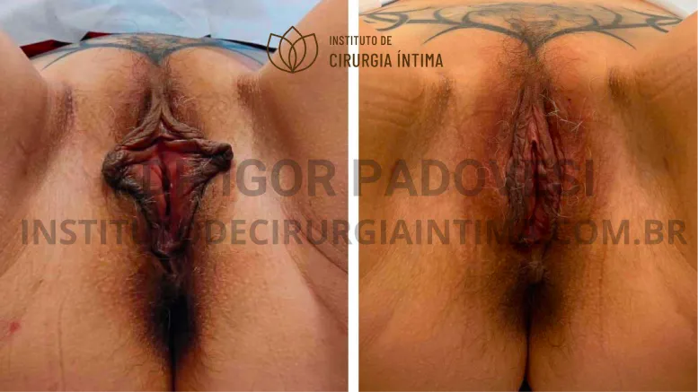 exemplos_ninfoplastias_capuz_clitoriano_set26_part1_Página_11_Imagem_0001 1_1x