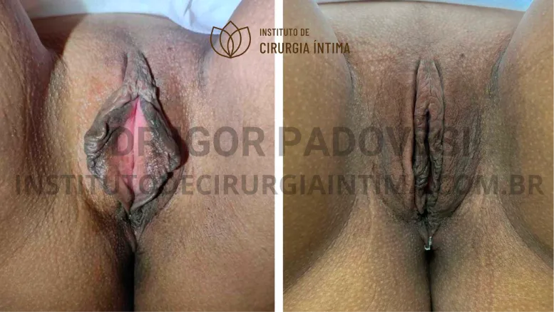 exemplos_ninfoplastias_capuz_clitoriano_set26_part1_Página_12_Imagem_0001 1_1x