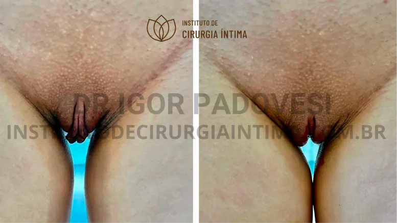 exemplos_ninfoplastias_capuz_clitoriano_set26_part1_Página_13_Imagem_0001 1_1x