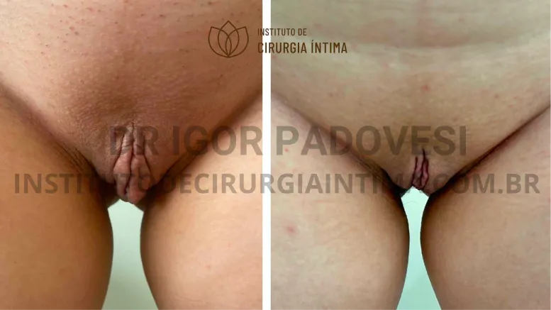 exemplos_ninfoplastias_capuz_clitoriano_set26_part1_Página_14_Imagem_0001 1_1x