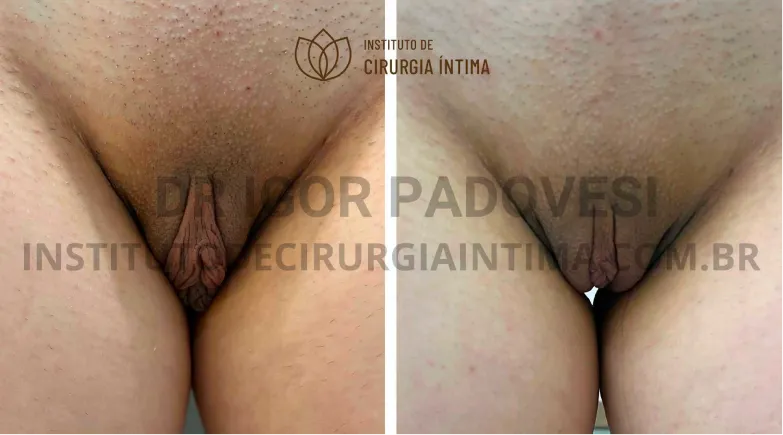 exemplos_ninfoplastias_capuz_clitoriano_set26_part1_Página_15_Imagem_0001 1_1x