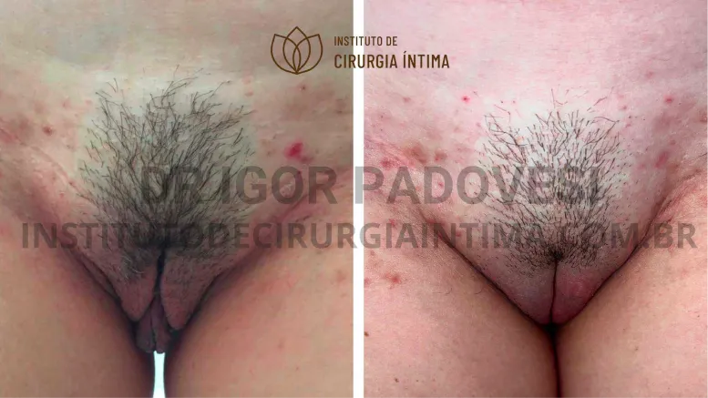 exemplos_ninfoplastias_capuz_clitoriano_set26_part1_Página_16_Imagem_0001 1_1x