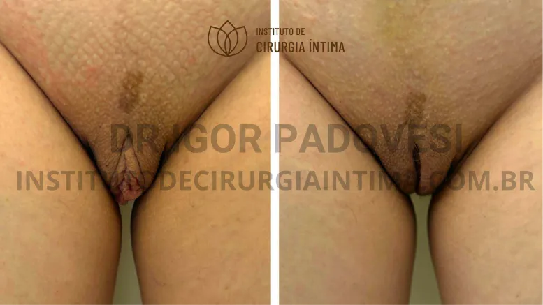 exemplos_ninfoplastias_capuz_clitoriano_set26_part1_Página_18_Imagem_0001 1_1x
