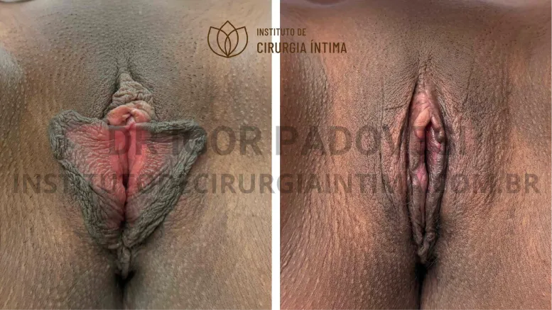 exemplos_ninfoplastias_capuz_clitoriano_set26_part1_Página_20_Imagem_0001 1_1x