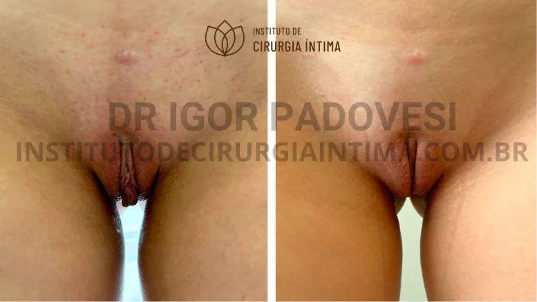 exemplos_ninfoplastias_capuz_clitoriano_set26_part1_Página_24_Imagem_0001 1_1x