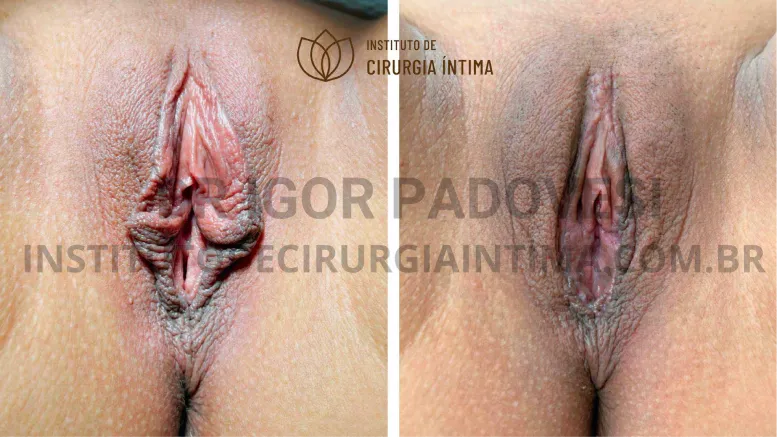exemplos_ninfoplastias_capuz_clitoriano_set26_part1_Página_28_Imagem_0001 1_1x