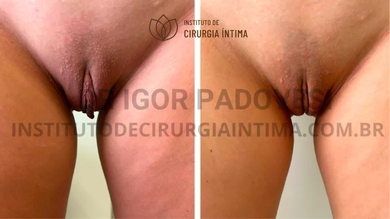 exemplos_ninfoplastias_capuz_clitoriano_set26_part1_Página_29_Imagem_0001 1_1x