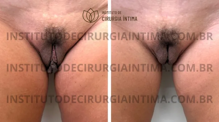 exemplos_ninfoplastias_capuz_clitoriano_set26_part2_Página_01_Imagem_0001 1_1x