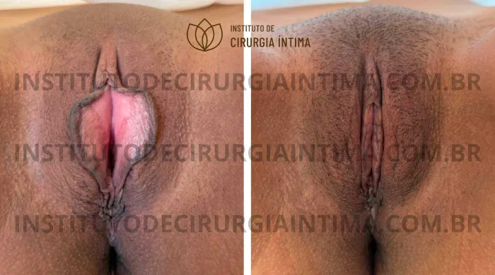 exemplos_ninfoplastias_capuz_clitoriano_set26_part2_Página_03_Imagem_0001 1_1x