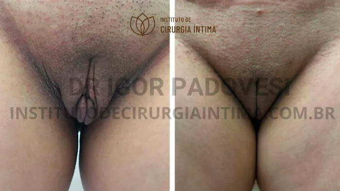 exemplos_ninfoplastias_capuz_clitoriano_set26_part2_Página_05_Imagem_0001 1_1x