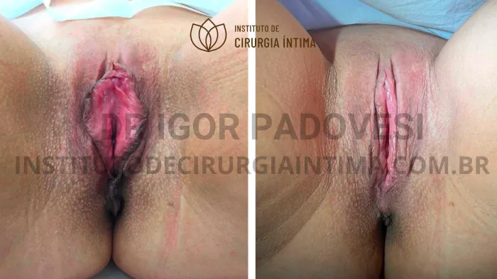 exemplos_ninfoplastias_capuz_clitoriano_set26_part2_Página_09_Imagem_0001 1_1x