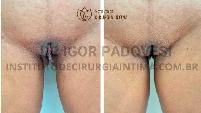 exemplos_ninfoplastias_capuz_clitoriano_set26_part2_Página_11_Imagem_0001 1_1x