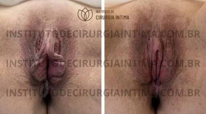 exemplos_ninfoplastias_capuz_clitoriano_set26_part2_Página_12_Imagem_0001 1_1x