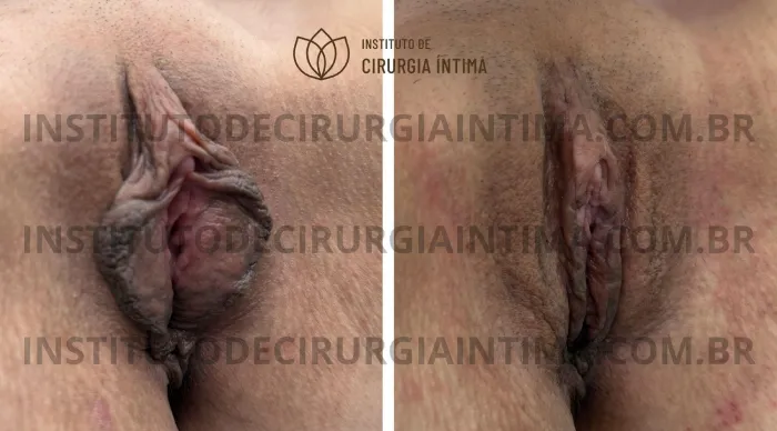 exemplos_ninfoplastias_capuz_clitoriano_set26_part2_Página_16_Imagem_0001 1_1x