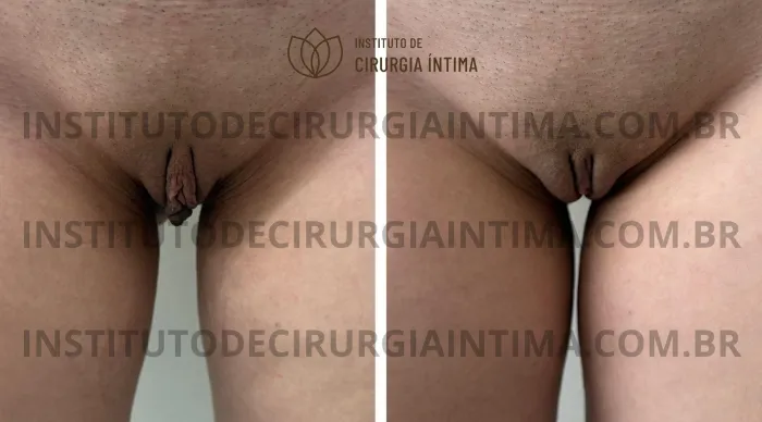 exemplos_ninfoplastias_capuz_clitoriano_set26_part2_Página_18_Imagem_0001 1_1x