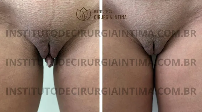 exemplos_ninfoplastias_capuz_clitoriano_set26_part2_Página_20_Imagem_0001 1_1x