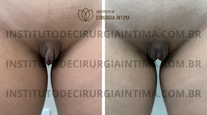 exemplos_ninfoplastias_capuz_clitoriano_set26_part2_Página_22_Imagem_0001 1_1x