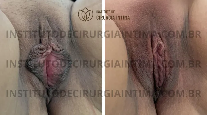 exemplos_ninfoplastias_capuz_clitoriano_set26_part2_Página_23_Imagem_0001 1_1x