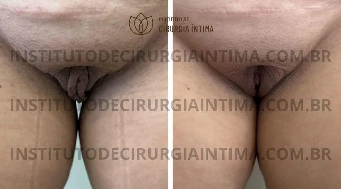 exemplos_ninfoplastias_capuz_clitoriano_set26_part2_Página_24_Imagem_0001 1_1x