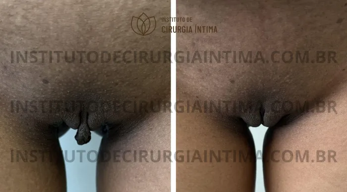 exemplos_ninfoplastias_capuz_clitoriano_set26_part2_Página_25_Imagem_0001 1_1x