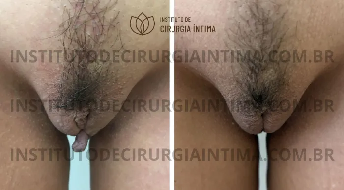 exemplos_ninfoplastias_capuz_clitoriano_set26_part2_Página_27_Imagem_0001 1_1x